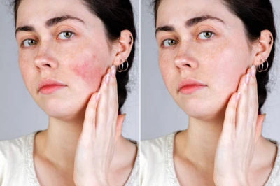 Dermatologista especialista em acne