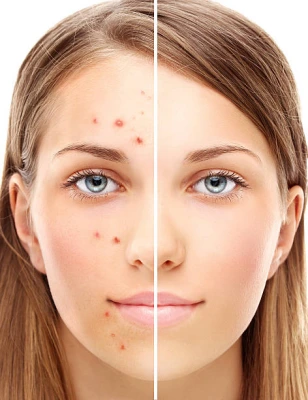 Dermatologista especialista em acne adulta