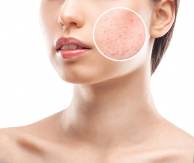Dermatologista especialista em acne hormonal