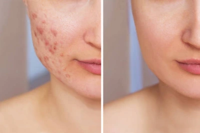Tratamento de acne e manchas