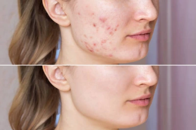 Tratamento para manchas de acne na Anália Franco