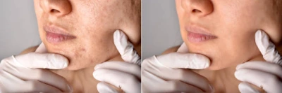 Tratamento para manchas de acne na Mooca