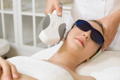 Tratamento de melasma com laser na Mooca